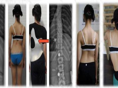 Schroth Best Practice Program Module A+B image